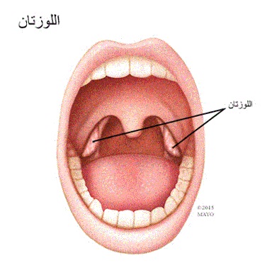 استئصال اللوزتين P_1892knai81